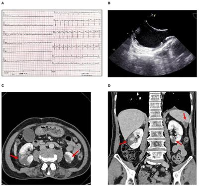 Case Report: Acute Renal and Splenic Infarctions Secondary to Atrial Fibrillation